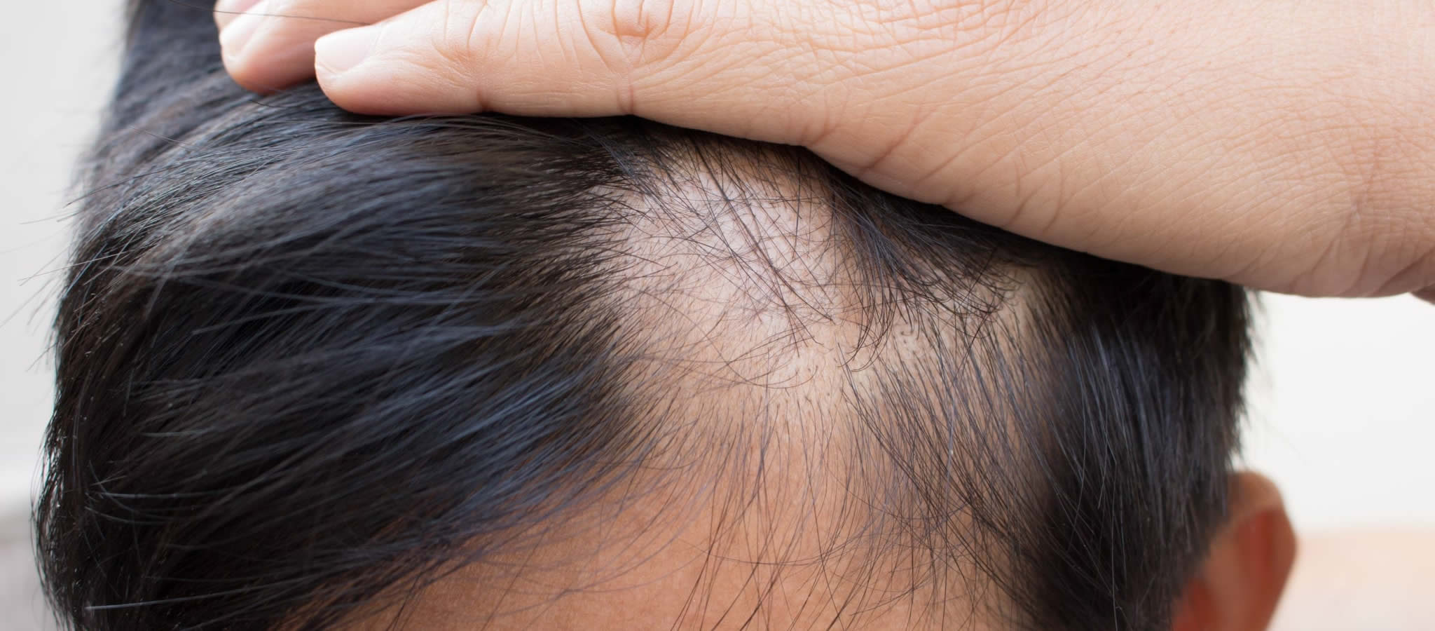 A Guide to Stopping Hormonal Hair Loss | Vibrant Dermatology