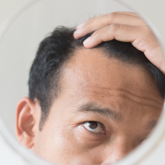 Male Hair Loss Treatment Srs Hair Clinic New Zealand Auckland