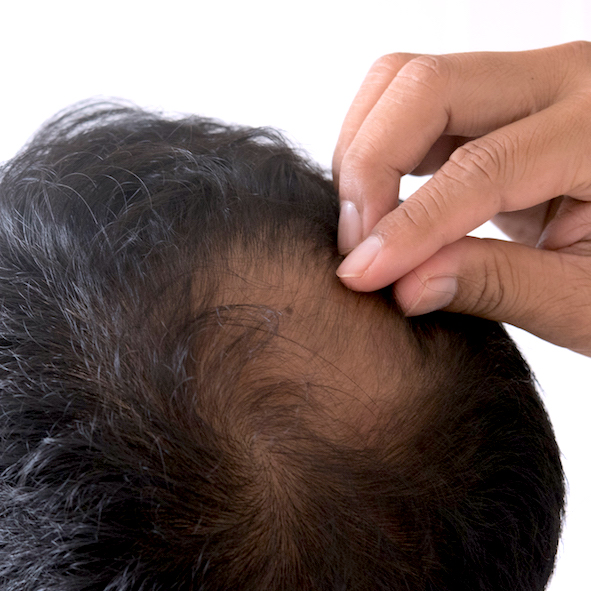 Male Hair Loss Treatment Srs Hair Clinic New Zealand Auckland