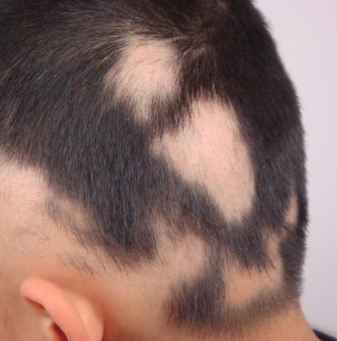 Alopecia-Areata SRS-Hair-Loss-Treatment