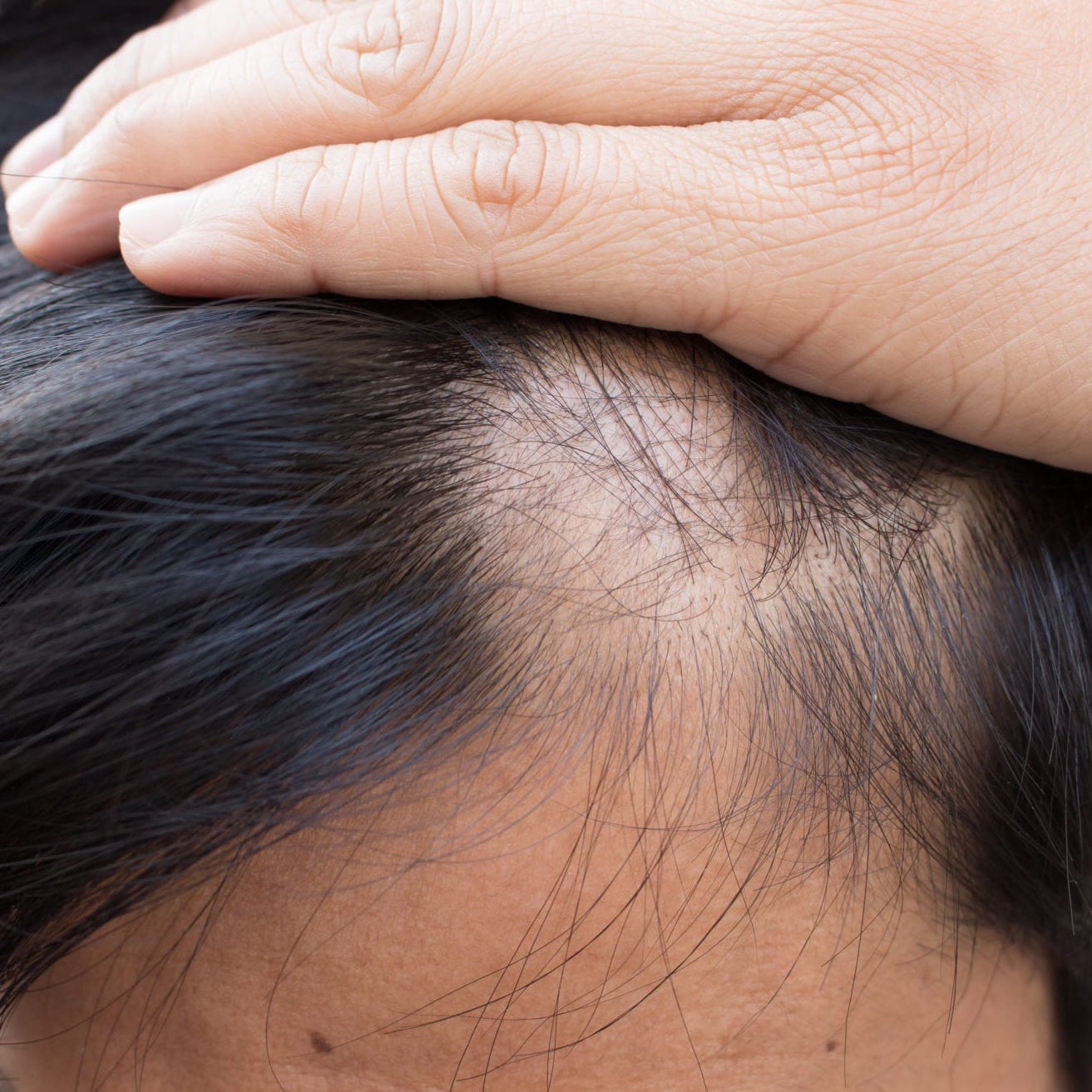 alopecia SRS-Hair-Loss-Treatment
