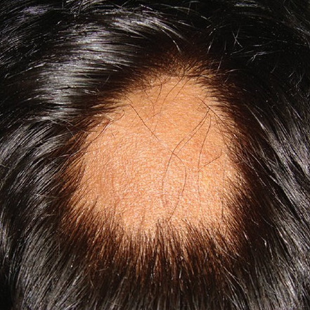 patchy1 SRS-Hair-Loss-Treatment